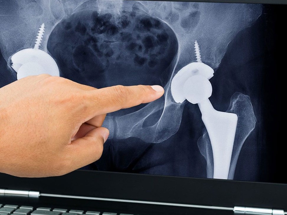 traumatólogo experto en cadera en Valencia - radiografía