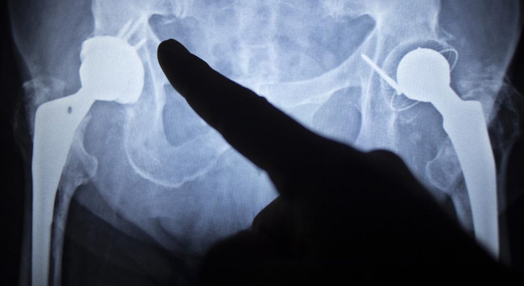 traumatólogo experto en cadera en Valencia - radiografía